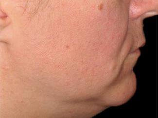 Skin Tightening Gallery Before & After Image