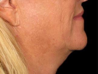 Skin Tightening Gallery Before & After Image