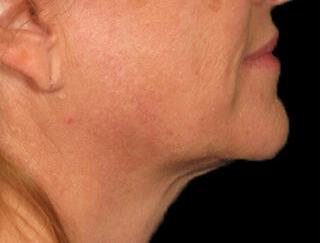 Skin Tightening Gallery Before & After Image