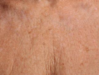 Skin Tightening Gallery Before & After Image