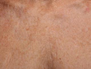 Skin Tightening Gallery Before & After Image