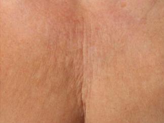 Skin Tightening Gallery Before & After Image