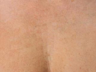 Skin Tightening Gallery Before & After Image