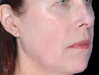 Skin Tightening Gallery Before & After Image