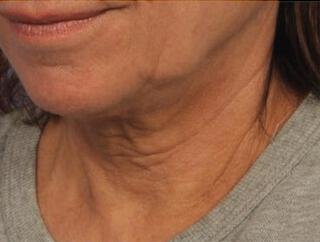 Skin Tightening Gallery Before & After Image