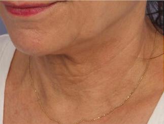 Skin Tightening Gallery Before & After Image