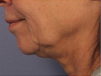 Skin Tightening Gallery Before & After Image