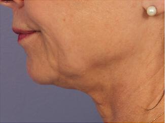 Skin Tightening Gallery Before & After Image