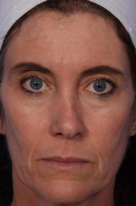 Thermage® Gallery Before & After Image