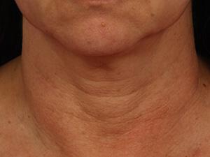 Ultherapy Gallery Before & After Image